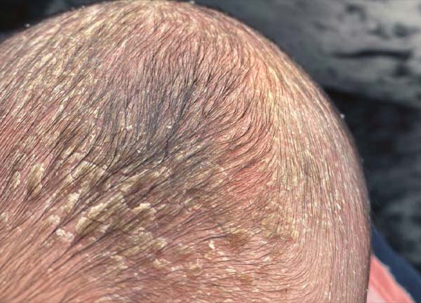 Cradle Cap